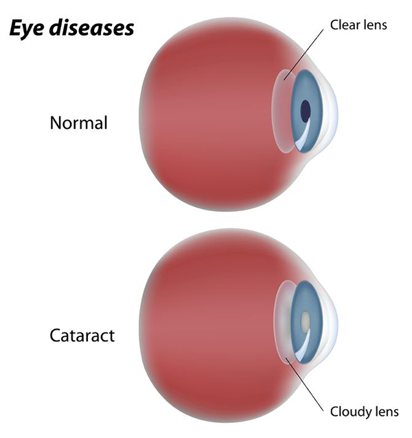 Cataracts in Royal Oak
