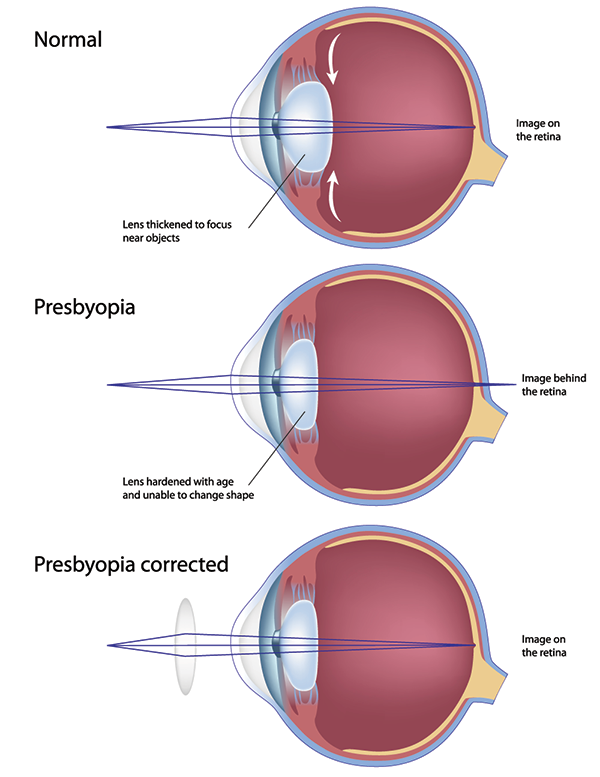 Presbyopia in Royal Oak