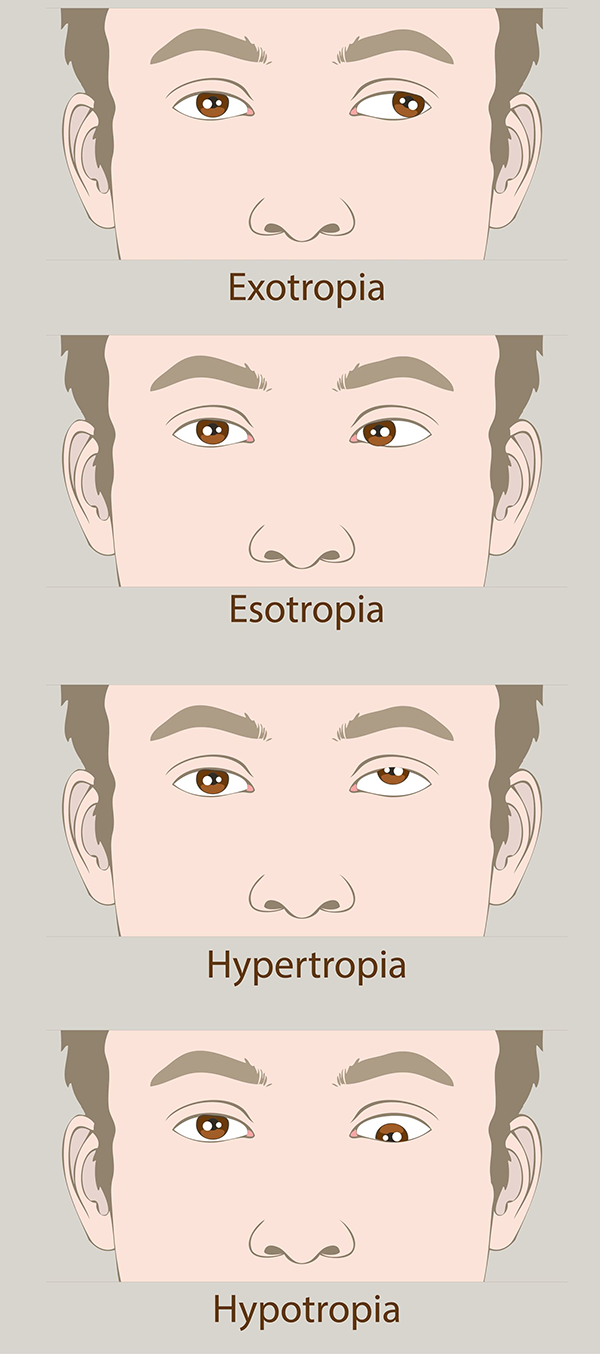 Amblyopia in Royal Oak