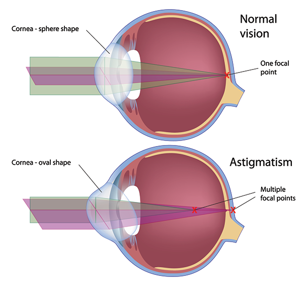 Astigmatism in Royal Oak