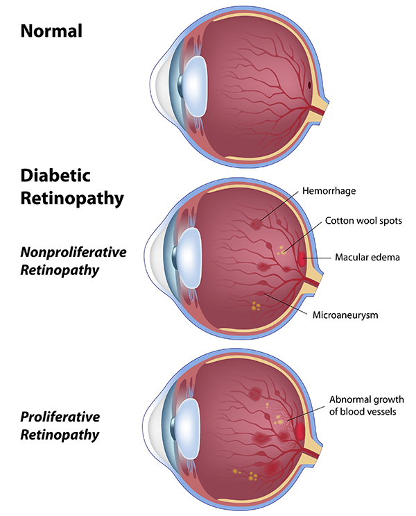 Diabetic Retinopathy in Royal Oak