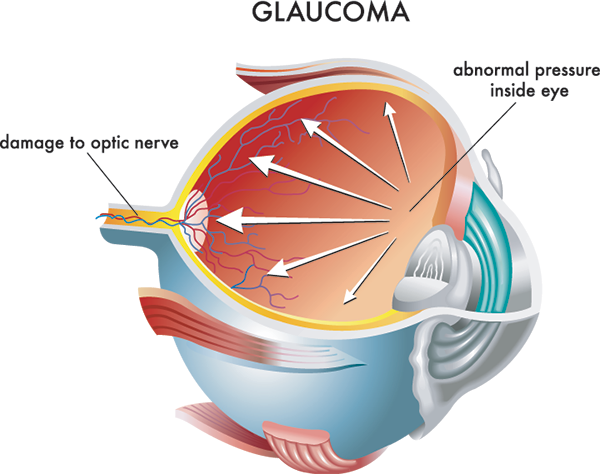 Glaucoma Treatment in Royal Oak