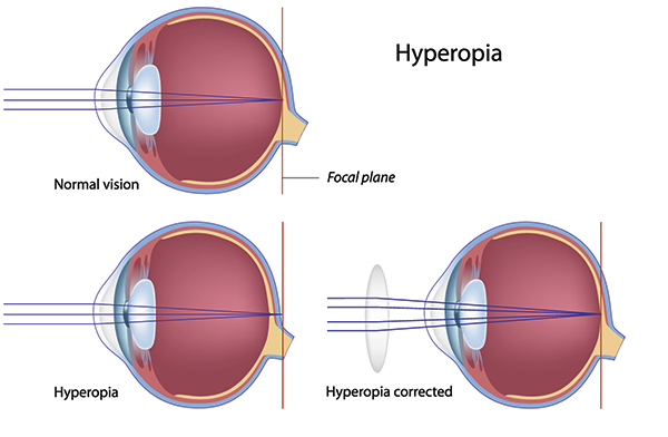 Farsightedness in Royal Oak