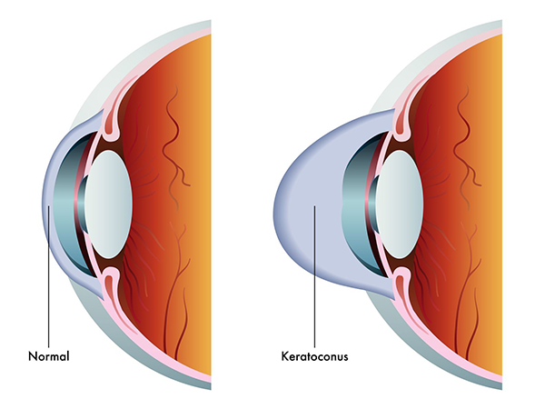 Keratoconus in Royal Oak