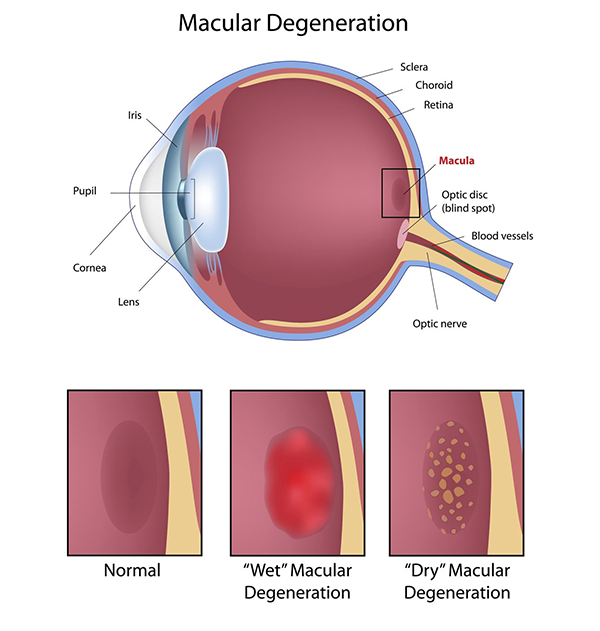 Macular Degeneration in Royal Oak