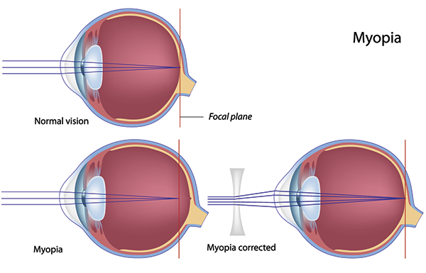 Nearsightedness in Royal Oak