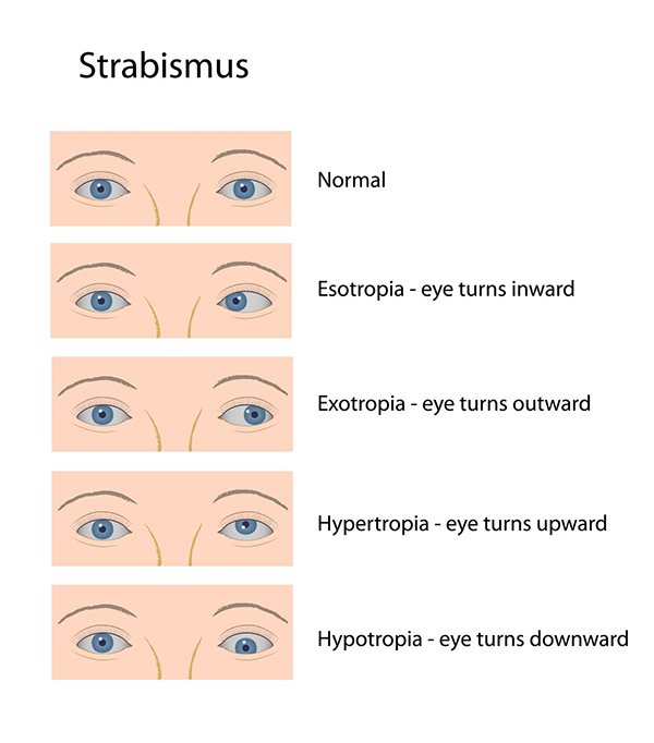 Strabismus in Royal Oak